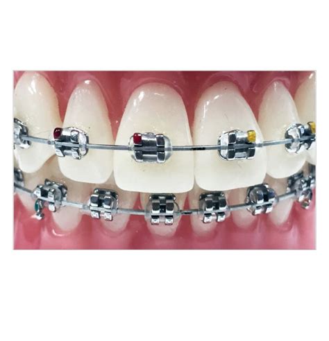 ortho metal brackets|stainless steel orthodontic braces.